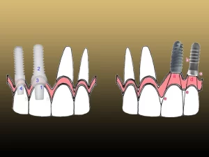 تفاوت ایمپلنت زیرکونیا و تیتانیوم