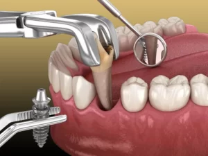 کشیدن دندان و ایمپلنت