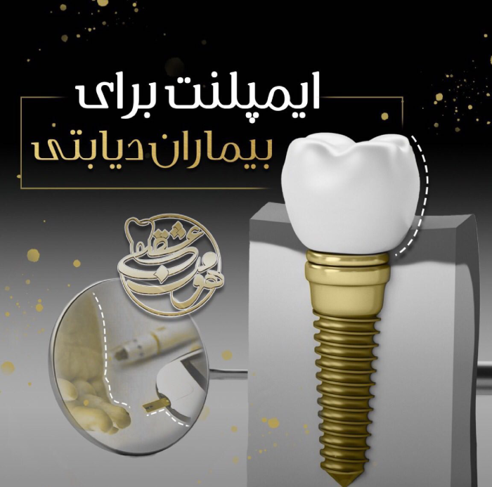 ایمپلنت برای بیماران دیابتی