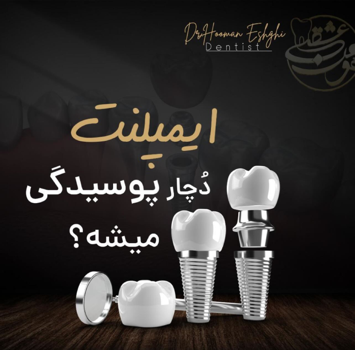 ایمپلنت دندان پوشیده