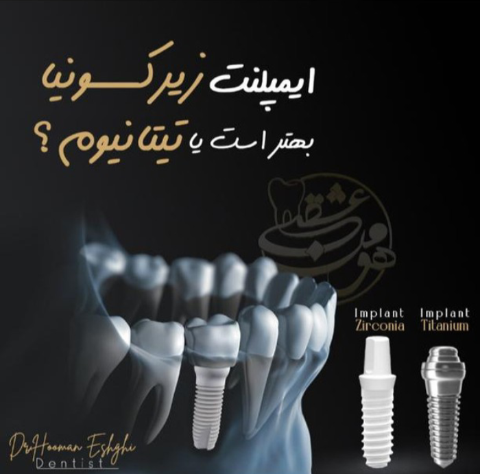 تفاوت ایمپلنت زیرکونیا با تیتانیوم