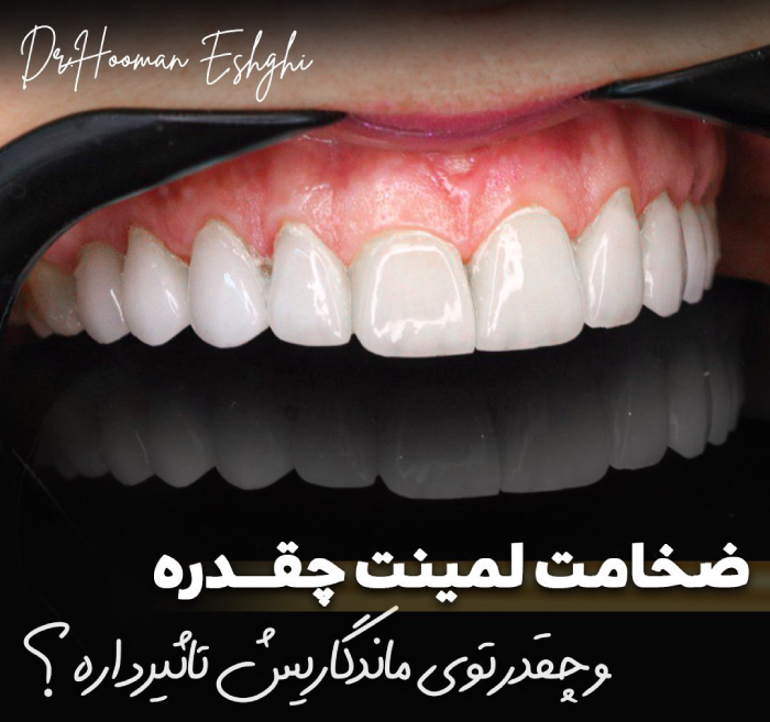 ضخامت لمینت دندان