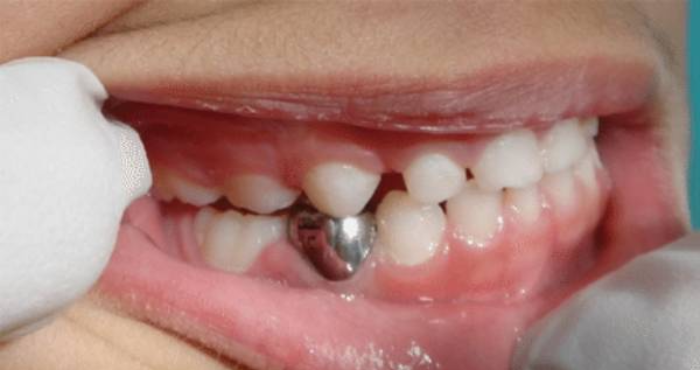 روکش دندان در کودکان