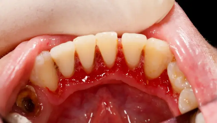 خونریزی در لثه ها