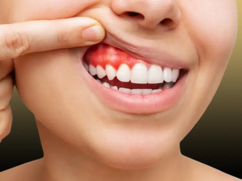 خونریزی لثه