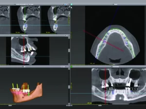 ایمپلنت دیجیتال دندان