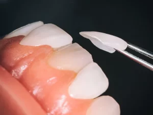 هر واحد لمینت دندان