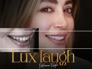 کامپوزیت لبه شیشه ای